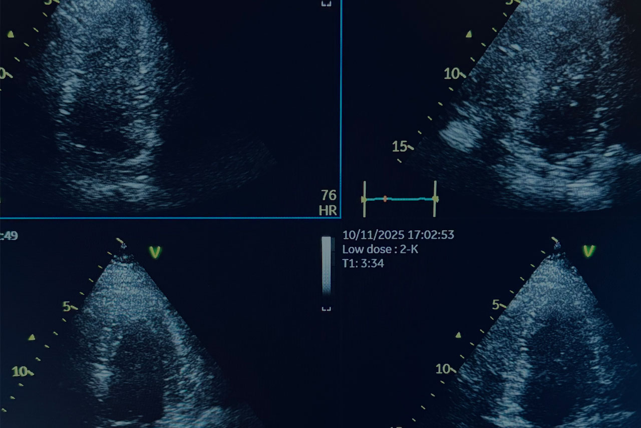 Stress-Echokardiographie